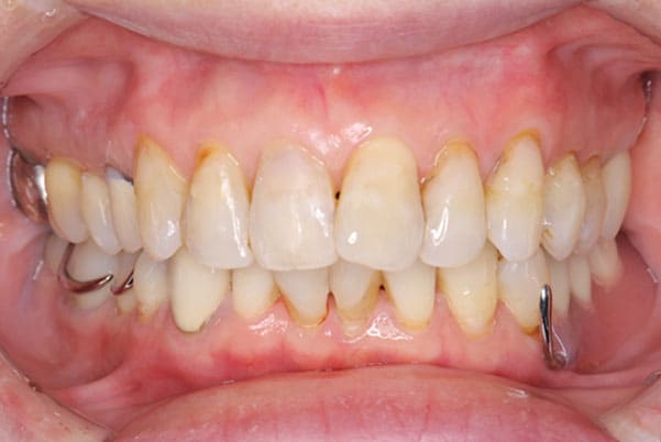 治療後の口腔内