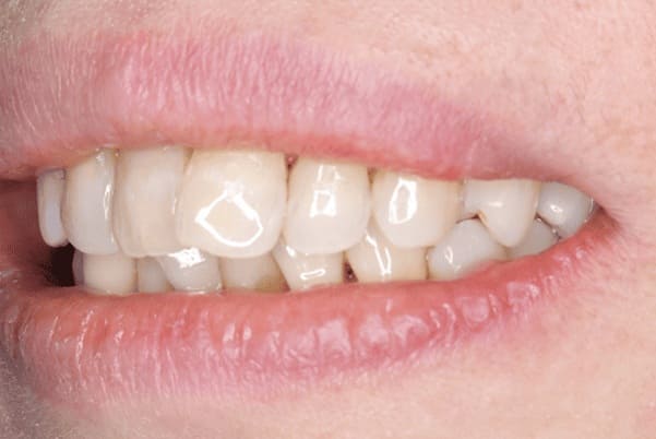 治療後の斜めからの口元