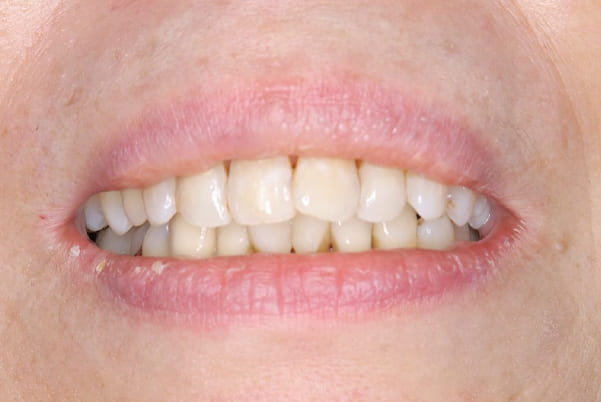 義歯が合わず痛い、見た目も気になる治療後