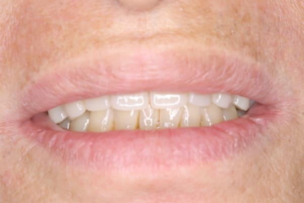 口を開けたときの口元