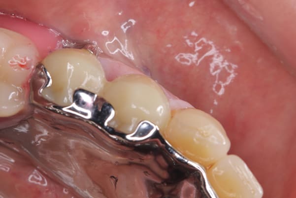 バネがかかる歯の被せ物01