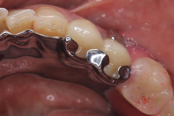 バネがかかる歯の被せ物02