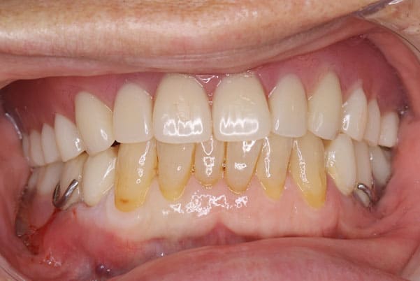 義歯がカパカパして痛い、歯がぐらぐらする治療後