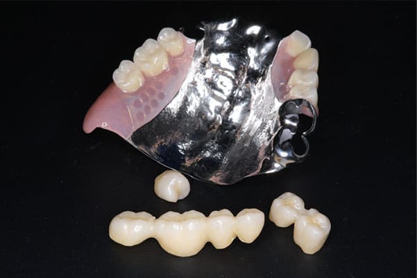 部分入れ歯と対合歯