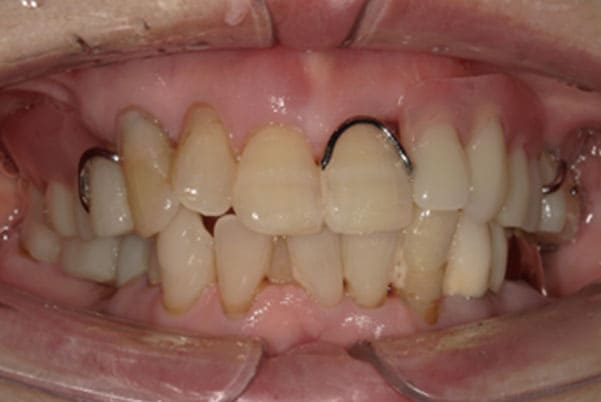 入れ歯が外れる、見た目も改善したい治療前