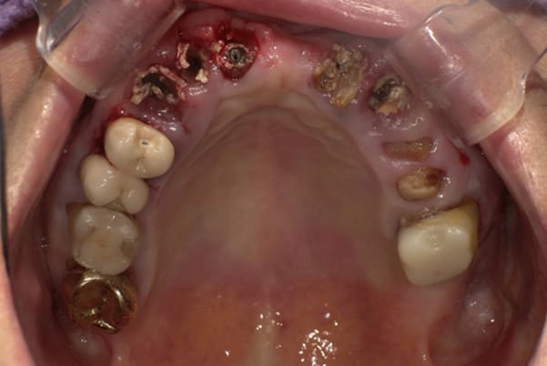 前歯がとれて痛い、食事もできず、見た目も悪いの上顎咬合面治療前