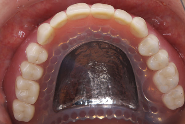 前歯がとれて痛い、食事もできず、見た目も悪いの上顎咬合面治療後