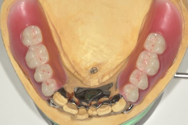 前歯がとれて痛い、食事もできず、見た目も悪いの完成前に適合や見た目のチェック