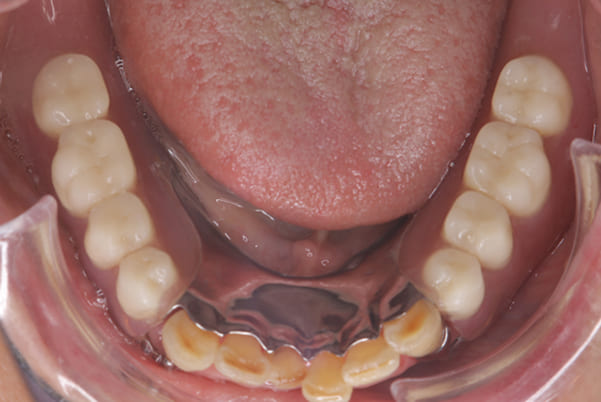 前歯がとれて痛い、食事もできず、見た目も悪いの下顎咬合面治療後