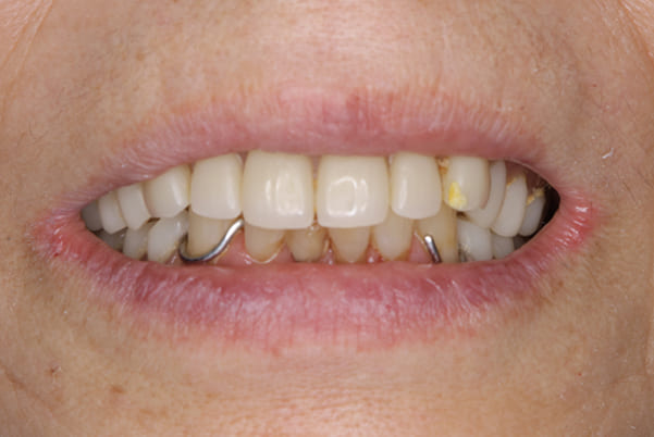 前歯がとれて痛い、食事もできず、見た目も悪いの治療用入れ歯