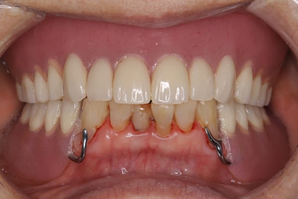 前歯がとれて痛い、食事もできず、見た目も悪い治療後