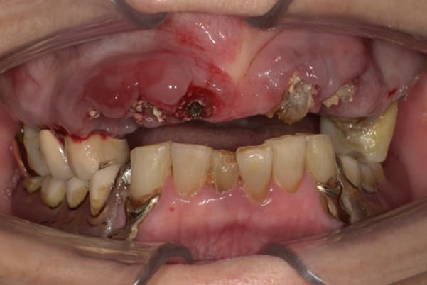 前歯がとれて痛い、食事もできず、見た目も悪い治療前