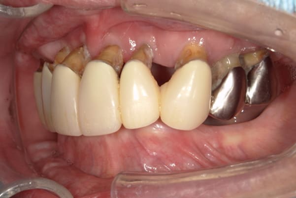 食事ができるようになりたい 左側面治療前