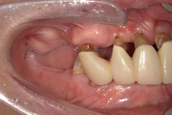 食事ができるようになりたい 右側面治療前