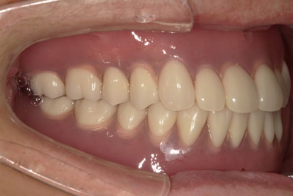 食事ができるようになりたい 右側面治療後