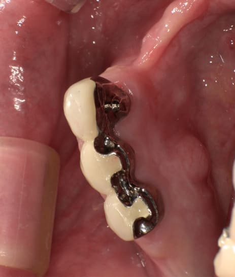 陶材焼着付鋳造冠ミリングラべット加工治療前
