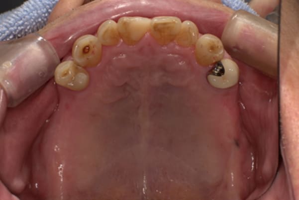 治療後に入れ歯を外した上顎