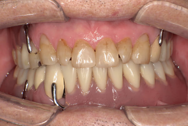 下歯がぐらぐらで痛い、咬めるようになりたい治療後