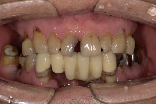 下歯がぐらぐらで痛い、咬めるようになりたい治療前