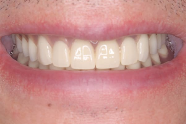 子供の結婚式で恥ずかしくないようにしたい治療後の口元