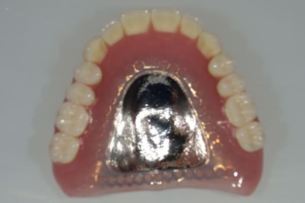 上顎金属床入れ歯