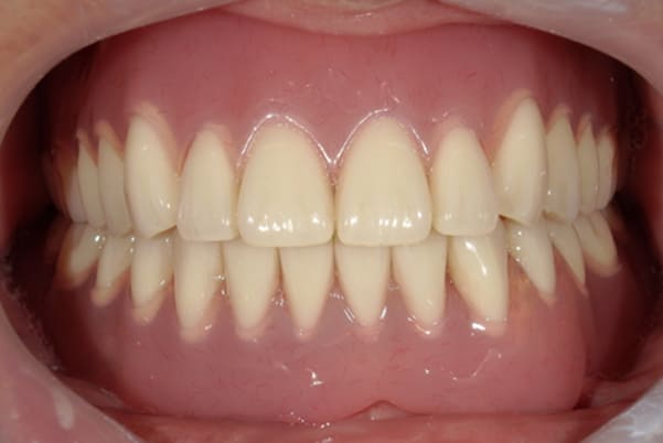 下の入れ歯は痛くて使わなくなった治療後