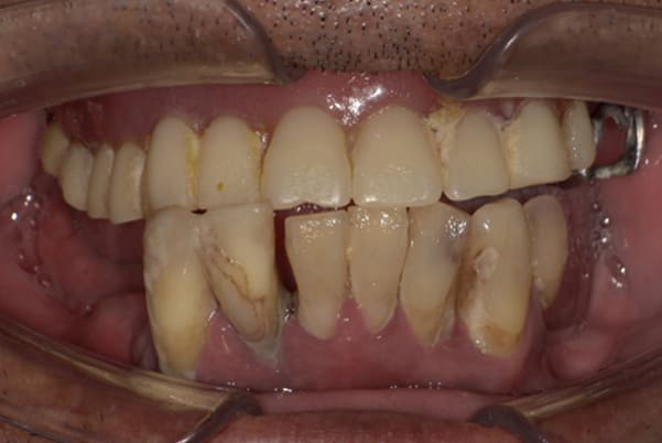 下の入れ歯は痛くて使わなくなった治療前