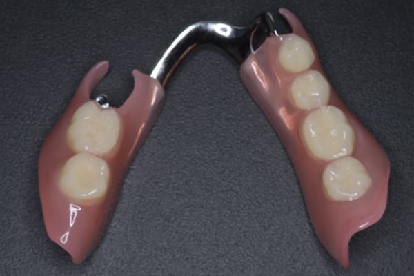 下顎の部分入れ歯2