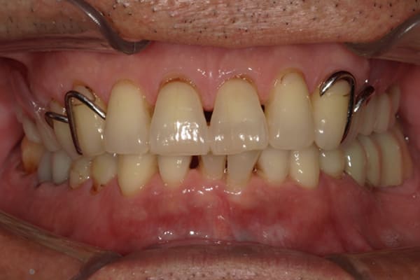 違和感なく安定剤なしで話せて、食べられる入れ歯を治療前