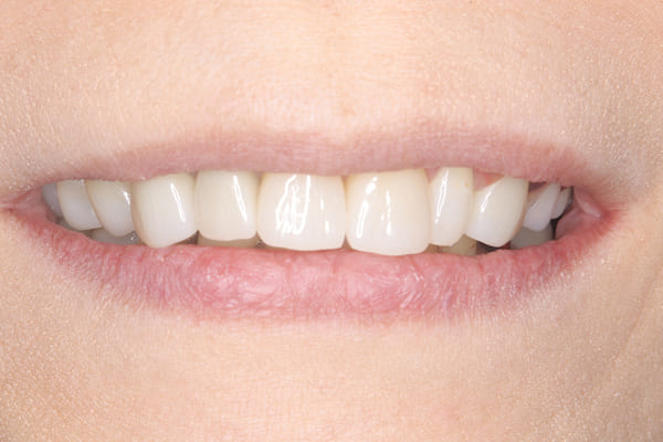 金属のバネがなく自然な口元に