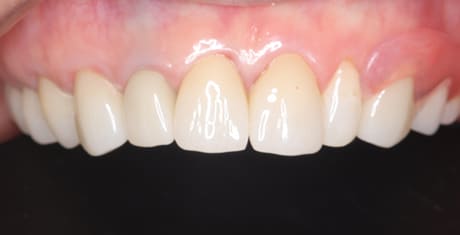 治療後の正面観の口腔内