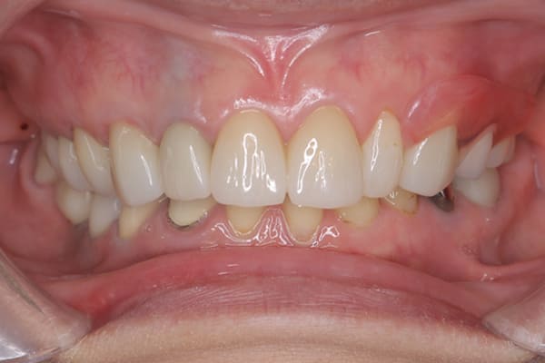 上の歯を綺麗に治したい治療後