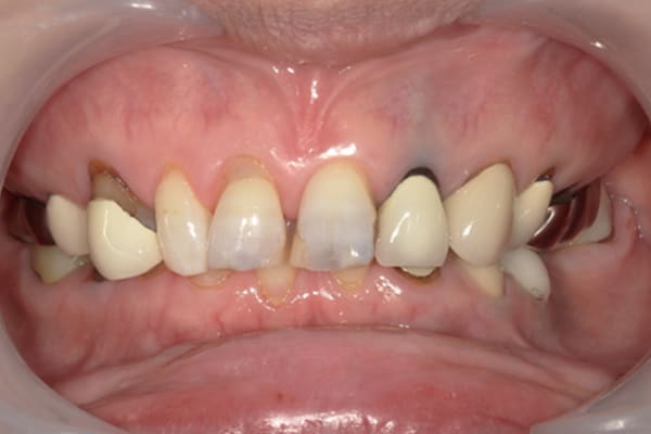 上の歯を綺麗に治したい治療前