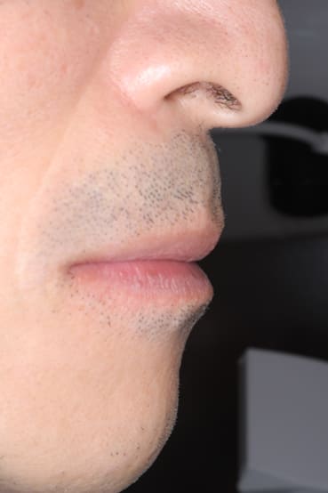 入れ歯をした状態