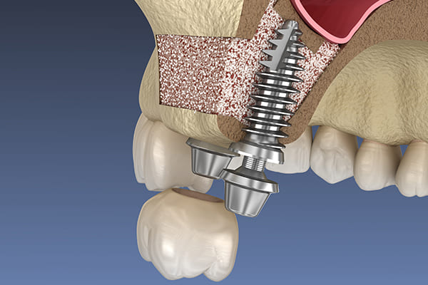 サイナスリフト