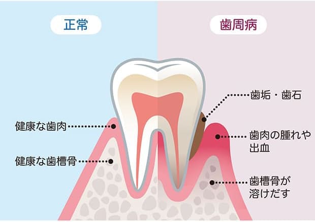 歯周病は自覚症状ないまま進行していく病気です