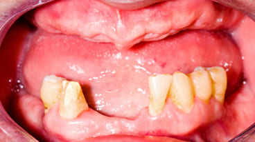 歯周病を放置するとどうなる？