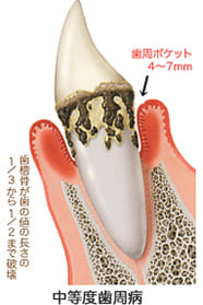 中等度歯周病（危険度★★★）